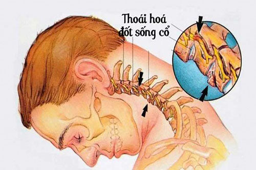 Thoái hóa đốt sống cổ gây mất ngủ: nguyên nhân & cách điều trị