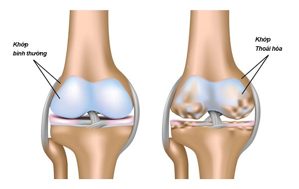 Cần biết về thoái hóa khớp gối