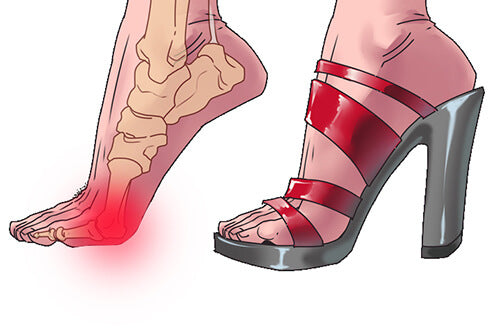 3 bộ phận dễ bị tổn thương khi phụ nữ đi giày cao gót nhiều