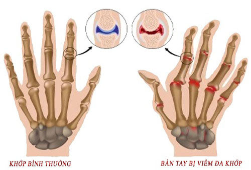 Đề phòng bệnh xương khớp vào mùa đông